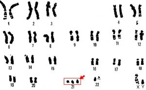 caryotype trisomie 21
